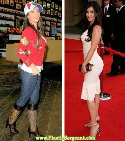 Kim Kardashian before and after butt implants