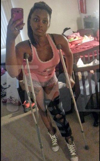  photo 0624-chris-brown-victim-leg-tmz-3_zps0f50e869.jpg