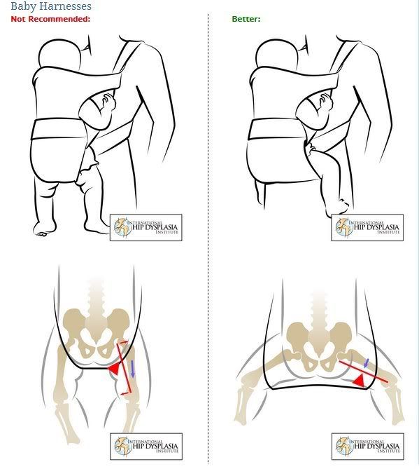 best baby carrier to prevent hip dysplasia